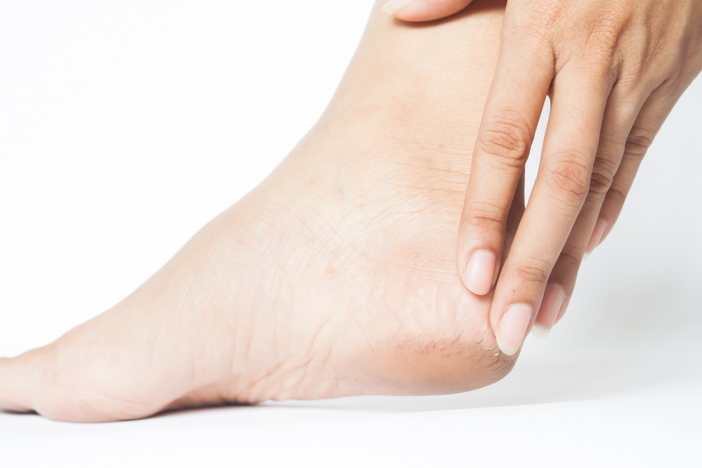 Seguro que muchos tenéis hiperqueratosis, pero no lo sabéis